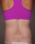 After SmartLipo™ Female Patient Back Angle View Case 3890