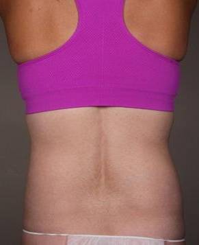 After SmartLipo™ Female Patient Back Angle View Case 3890