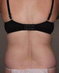 Before SmartLipo™ Female Patient Back Angle View Case 3890