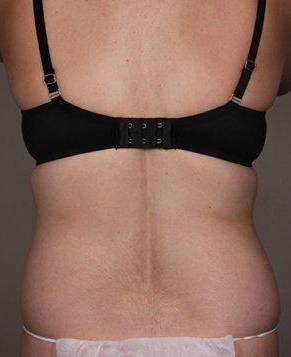 Before SmartLipo™ Female Patient Back Angle View Case 3890