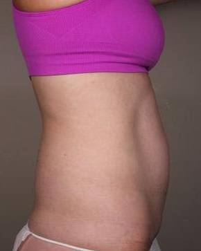 After SmartLipo™ Female Patient Side Angle View Case 3890