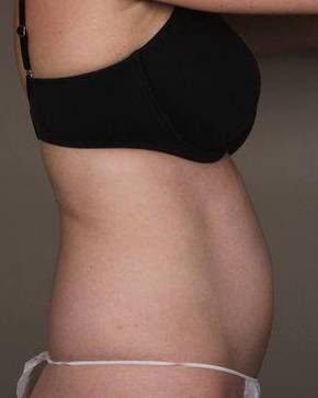 Before SmartLipo™ Female Patient Side Angle View Case 3890
