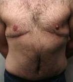 after male tummy tuck front view case 3794