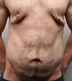 before male tummy tuck front view case 3794