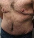 after male tummy tuck left front diagonal view case 3794