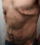 Before Male Tummy Tuck procedure left diagonal view case 3794