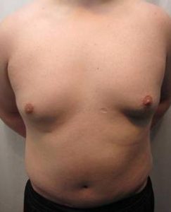 After Tummy Tuck Male Patient Front Angle View Case 3799