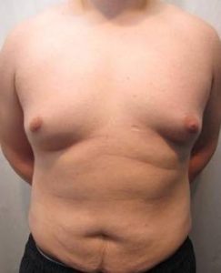 Before Tummy Tuck Male Patient Front Angle View Case 3799