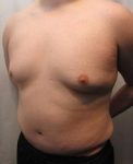 After Tummy Tuck Male Patient Diagonal Angle View Case 3799