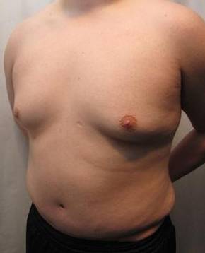 After Tummy Tuck Male Patient Diagonal Angle View Case 3799