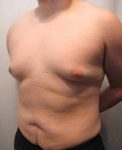 Before Tummy Tuck Male Patient Diagonal Angle View Case 3799