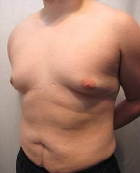 Before Tummy Tuck Male Patient Diagonal Angle View Case 3799