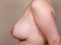 After Massive Weight Loss Surgery Female Patient Side Angle View Case 3898