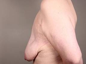 Before Massive Weight Loss Surgery Female Patient Side Angle View Case 3898