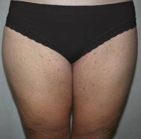 After Massive Weight Loss Surgery Female Patient Front Angle View Case 3903