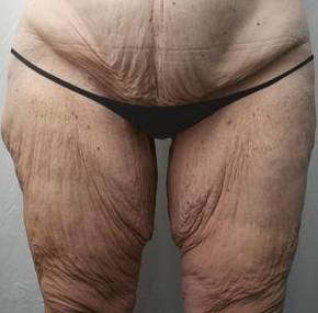 Before Massive Weight Loss Surgery Female Patient Front Angle View Case 3903