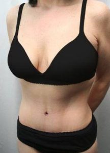 After Massive Weight Loss Surgery Female Patient Diagonal Angle View Case 3906