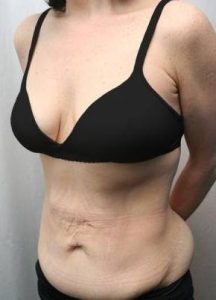 Before Massive Weight Loss Surgery Female Patient Diagonal Angle View Case 3906