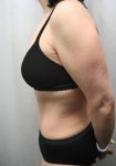 After Massive Weight Loss Surgery Female Patient Side Angle View Case 3906