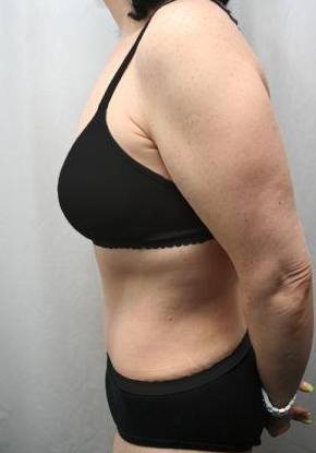 After Massive Weight Loss Surgery Female Patient Side Angle View Case 3906