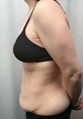 Before Massive Weight Loss Surgery Female Patient Side Angle View Case 3906