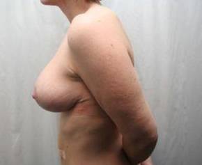 After Massive Weight Loss Surgery Female Patient Side Angle View Case 3911