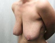 Before Massive Weight Loss Surgery Female Patient Diagonal Angle View Case 3911