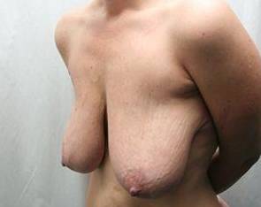 Before Massive Weight Loss Surgery Female Patient Diagonal Angle View Case 3911