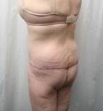 After Massive Weight Loss Surgery Female Patient Back Angle View Case 3918