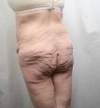 Before Massive Weight Loss Surgery Female Patient Back Angle View Case 3918