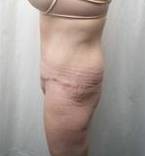 After Massive Weight Loss Surgery Female Patient Side Angle View Case 3918