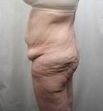 Before Massive Weight Loss Surgery Female Patient Side Angle View Case 3918
