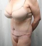 After Massive Weight Loss Surgery Female Patient Diagonal Angle View Case 3918