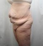 Before Massive Weight Loss Surgery Female Patient Diagonal Angle View Case 3918