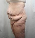 Before Massive Weight Loss Surgery Female Patient Diagonal Angle View Case 3918