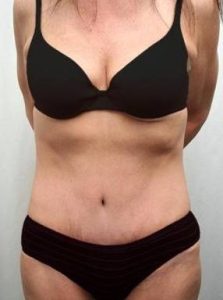 After Massive Weight Loss Surgery Female Patient Front Angle View Case 3925