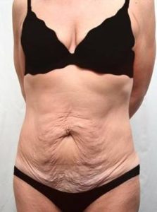Before Massive Weight Loss Surgery Female Patient Front Angle View Case 3925