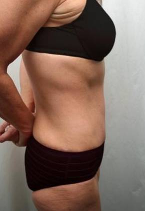 After Massive Weight Loss Surgery Female Patient Side Angle View Case 3925