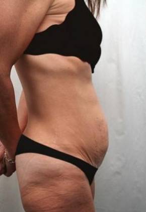 Before Massive Weight Loss Surgery Female Patient Side Angle View Case 3925