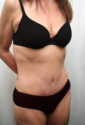 After Massive Weight Loss Surgery Female Patient Diagonal Angle View Case 3925