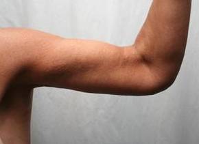 After Massive Weight Loss Surgery Female Patient left arm View Case 3933