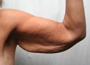 Before Massive Weight Loss Surgery Female Patient left arm View Case 3933