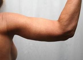 After Massive Weight Loss Surgery Female Patient right arm View Case 3933