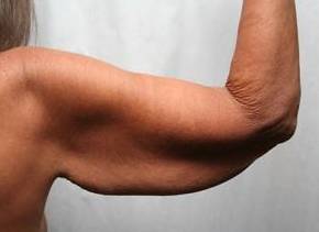 Before Massive Weight Loss Surgery Female Patient right arm View Case 3933