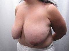 Before Massive Weight Loss Surgery Female Patient Diagonal Angle View Case 3938