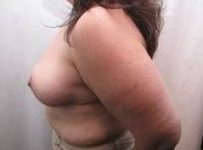 After Massive Weight Loss Surgery Female Patient Side Angle View Case 3938