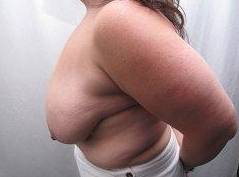 Before Massive Weight Loss Surgery Female Patient Side Angle View Case 3938