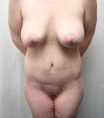 After Massive Weight Loss Surgery Female Patient Front Angle View Case 3944