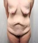 Before Massive Weight Loss Surgery Female Patient Front Angle View Case 3944