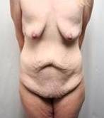 Before Massive Weight Loss Surgery Female Patient Front Angle View Case 3944